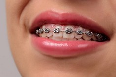Ortodoncia Brakets Metálicos Ortodoncia Brakets Metálicos