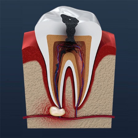 Caries_endodoncia_Fase1 Caries_endodoncia_Fase1