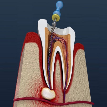 Endodoncia_Fase2 Endodoncia_Fase2