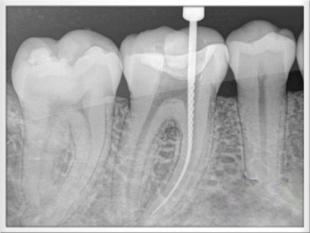 RX Endodoncias RX Endodoncias