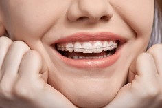 Brackets Cerámicos Brackets Cerámicos o Estéticos