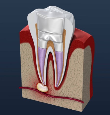 Endodoncia_Fase3 Endodoncia_Fase3