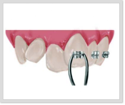 Fase 2 ortodocia Colocación Brackets