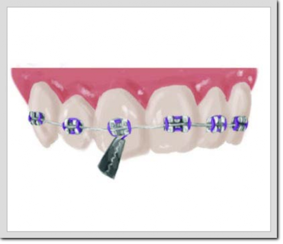 Fase 3 ortodoncia Ajuste Brackets