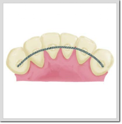 Fase 4 ortodoncia Retendor mantenimiento ortodoncia